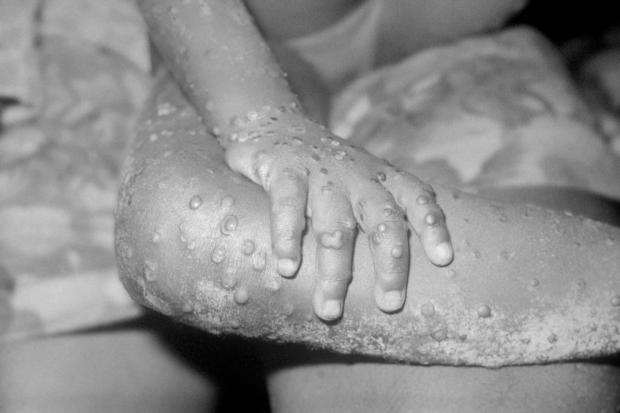 Whitehaven News: The monkeypox virus can be spread in a number of ways. Picture: PA
